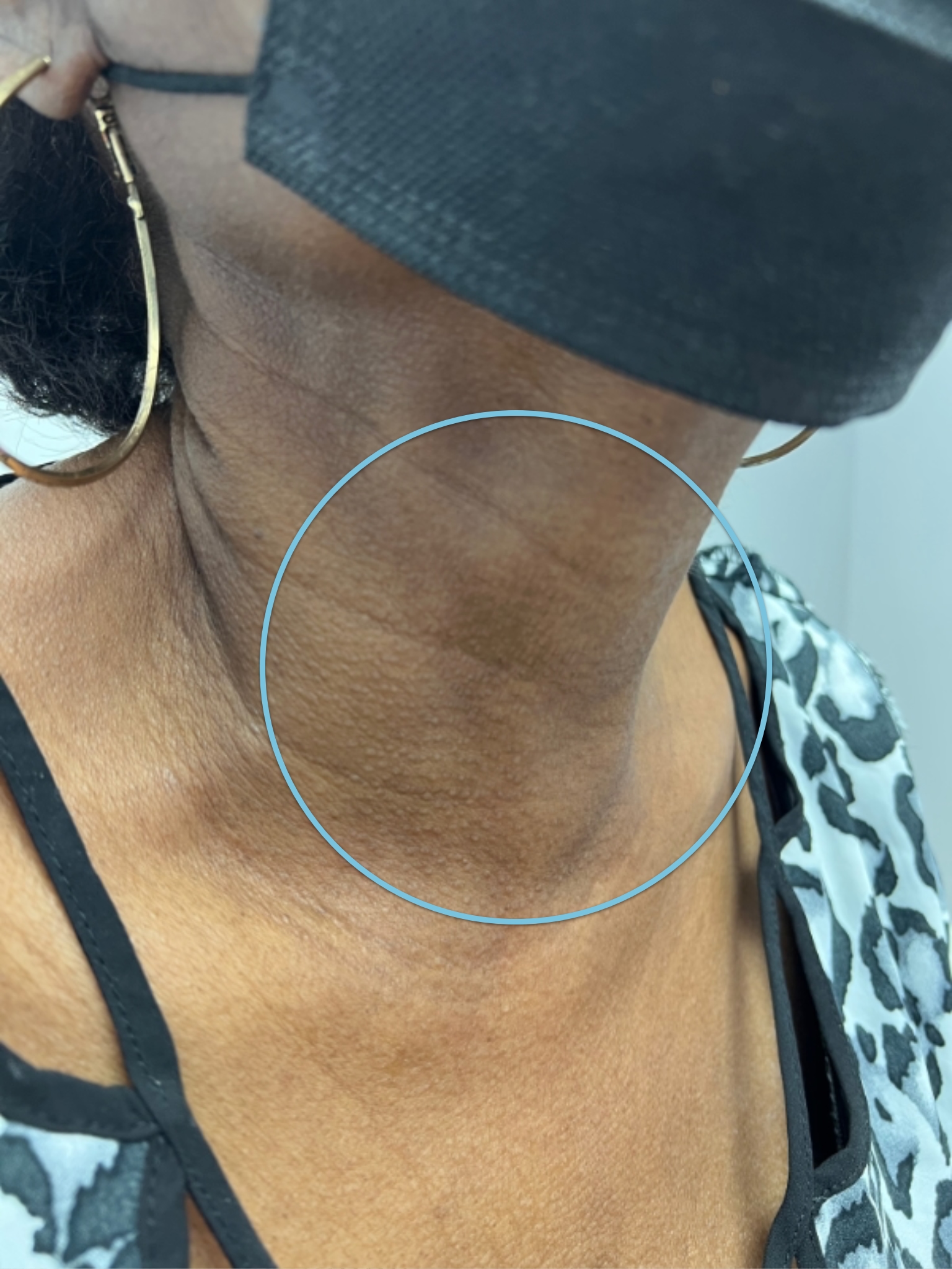 thyroid-after-v2